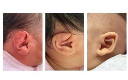 AMELİYATSIZ KULAK ŞEKİLLENDİRME