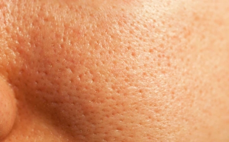 Gözenek görünümüne son vermenin en basit yolları